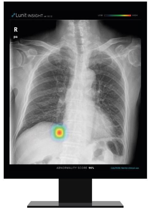 루닛 인사이트 CXR이 흉부 엑스레이 이미지에서 비정상 병변의 위치와 존재 확률값을 표시하는 모습