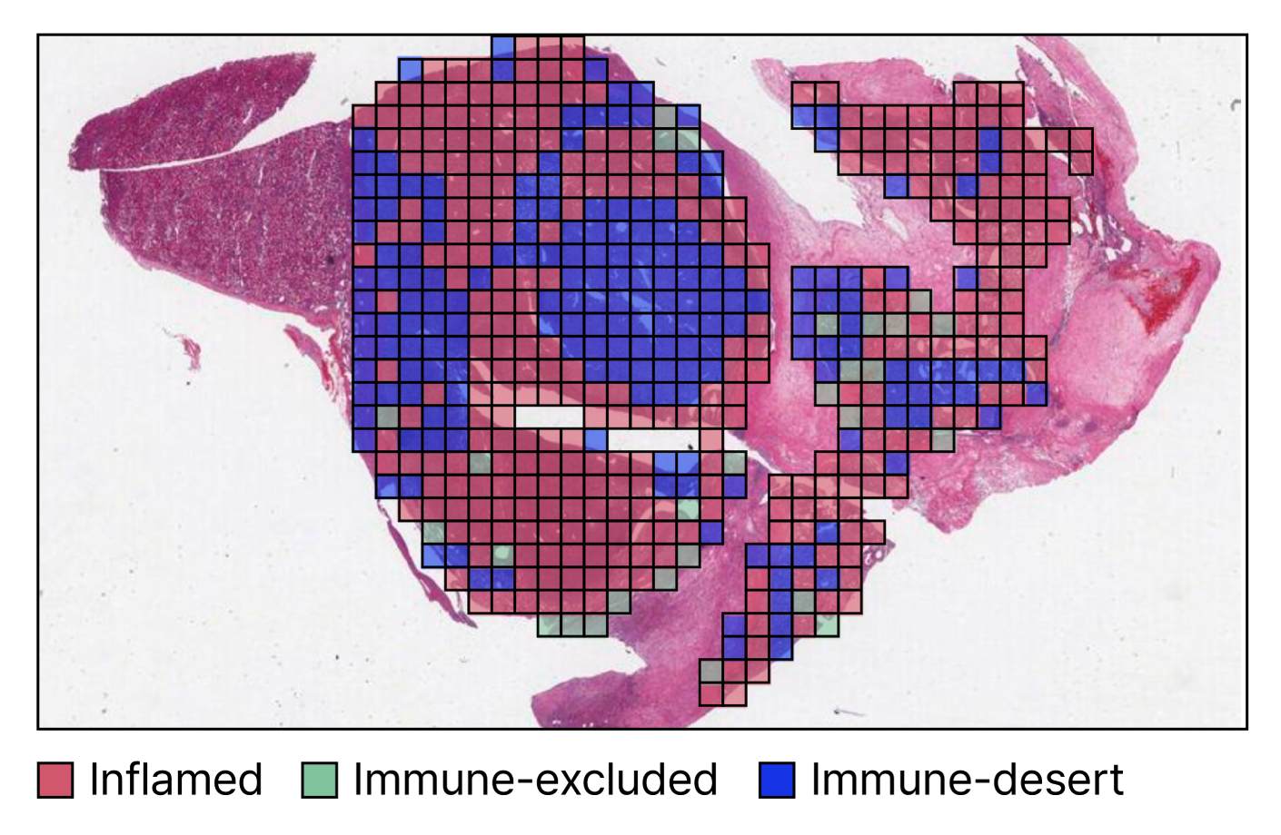 Tissue sample with AI-generated colored grid showing immune phenotypes labeled as inflamed, immune-excluded, and immune-desert to support companion diagnostic development.