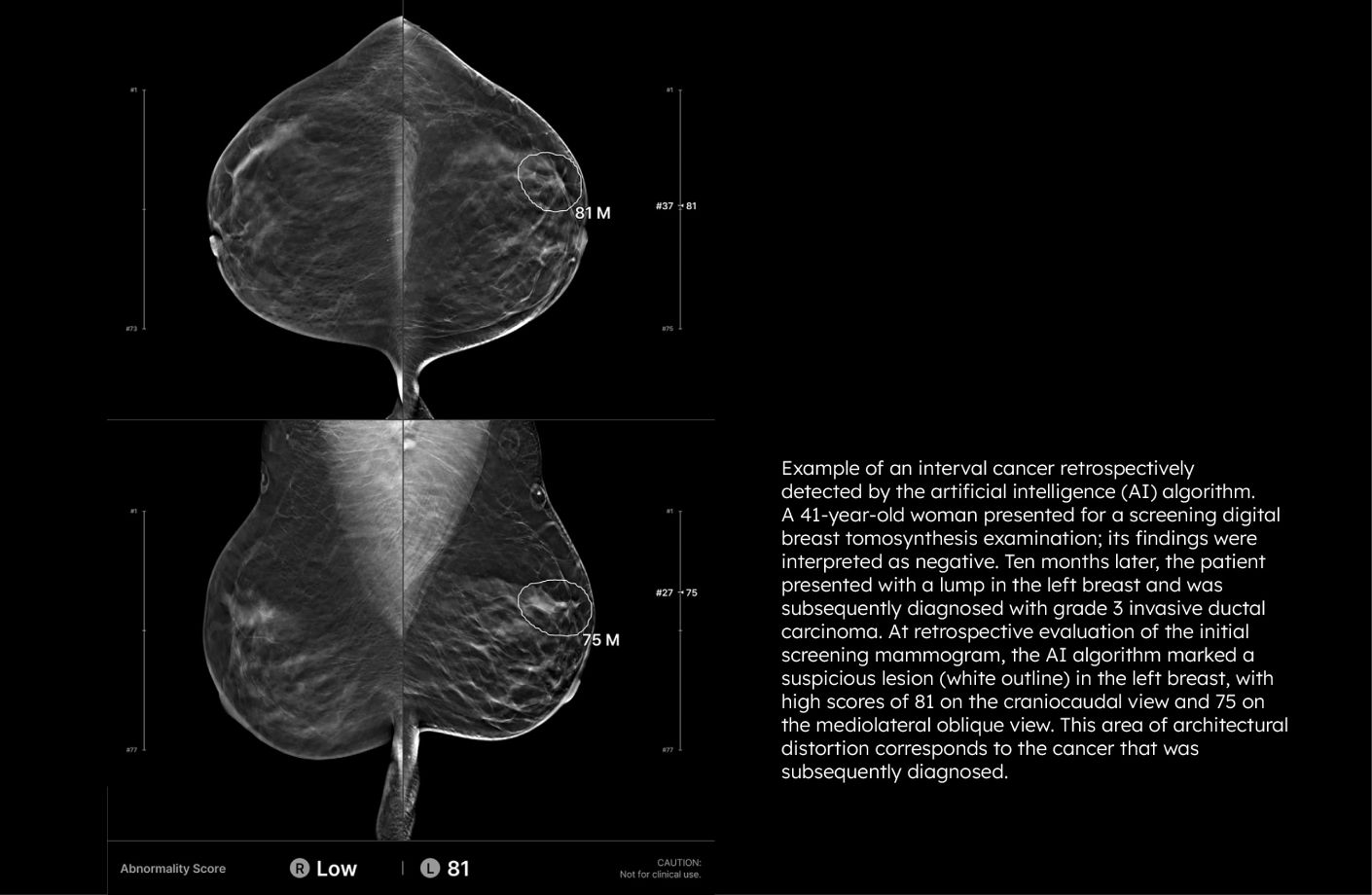 Mammogram comparison showing interval cancer detected by AI-assisted mammography that was missed in prior screening.