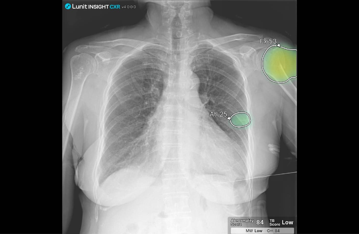 Chest x-ray image analyzed by AI highlighting subtle rib and clavicle fractures to improve diagnostic accuracy.