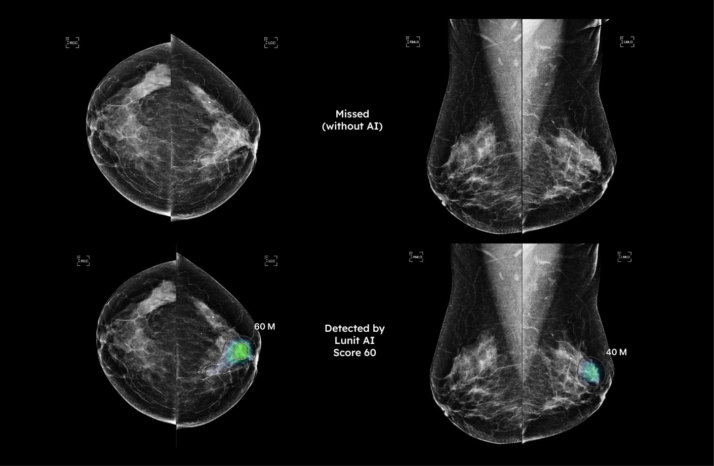 Comparison of mammograms showing lesion missed by radiologist but detected by AI mammography software, leading to earlier cancer diagnosis.