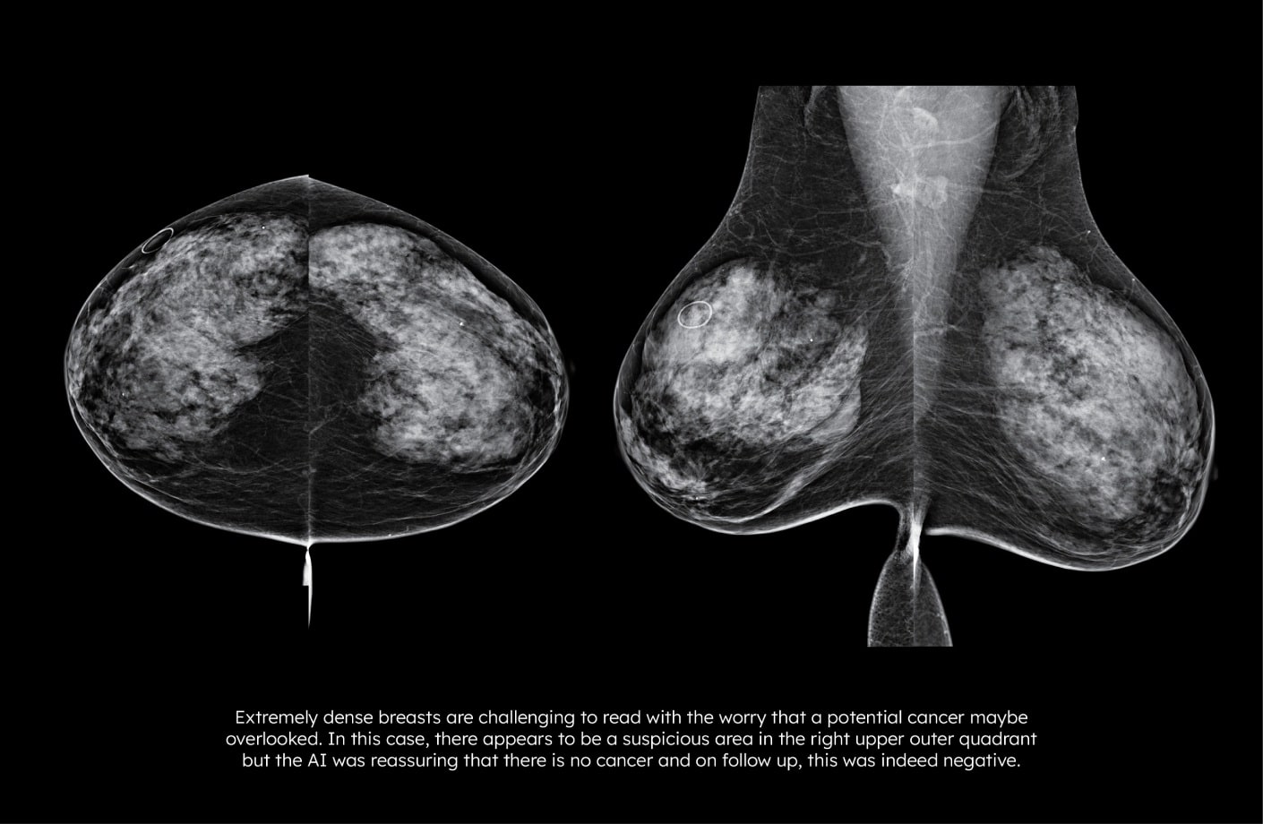 Mammogram comparison showing AI mammography software reducing false positives and follow-up callbacks by confirming absence of cancer.