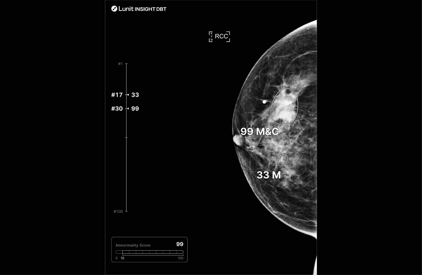 Annotated mammogram showing AI-assisted mammography highlighting lesions with heatmaps and malignancy scores for diagnostic decision support.