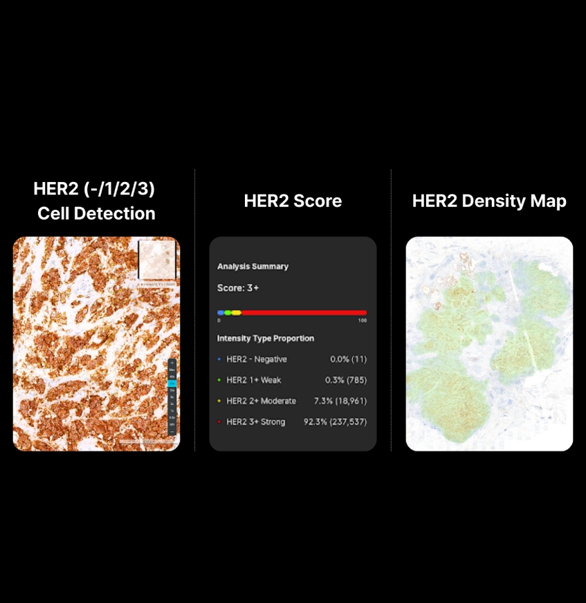 Enhance HER2 IHC Scoring with AI Analysis