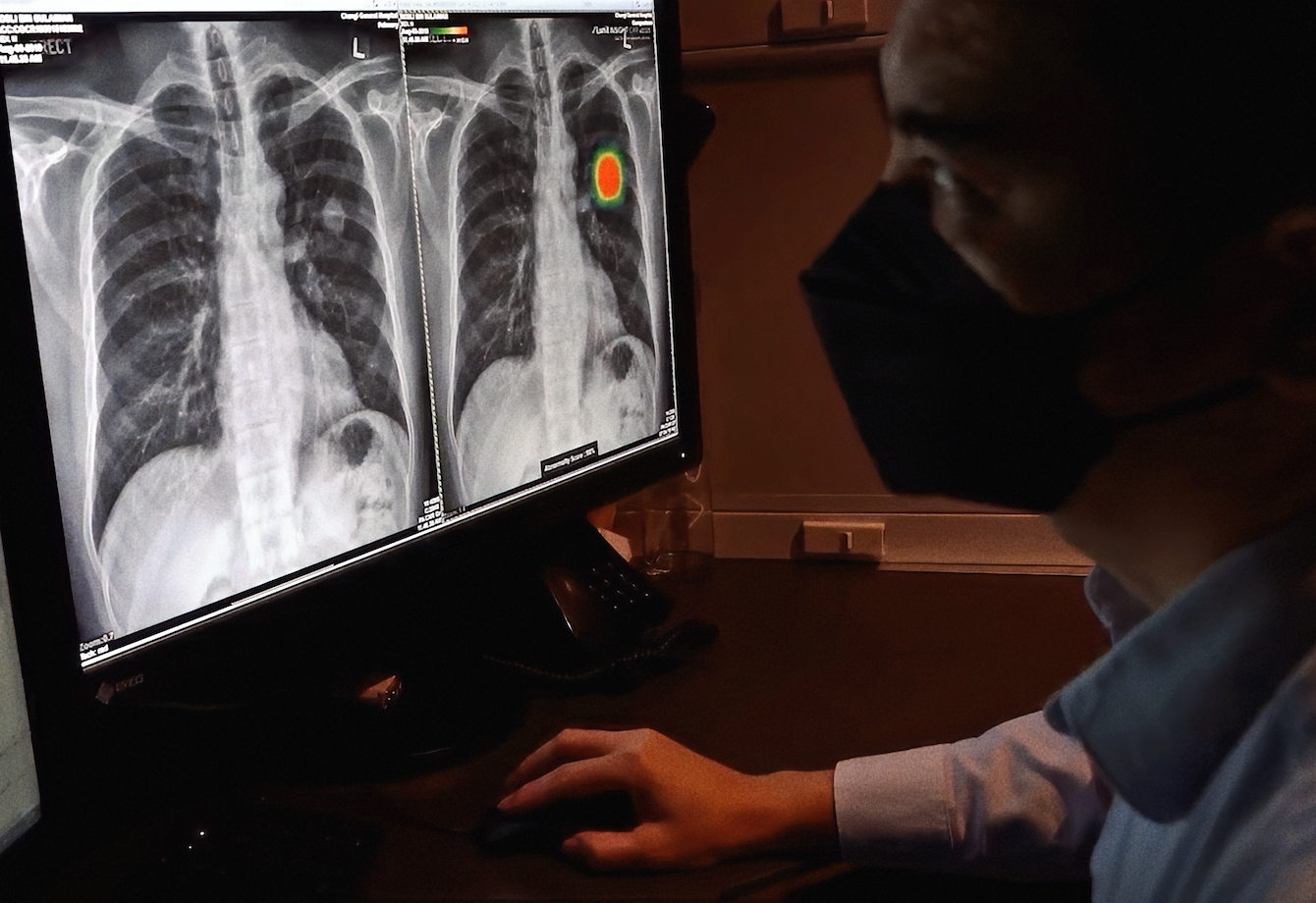 Transform Your Chest Imaging Workflow with AI