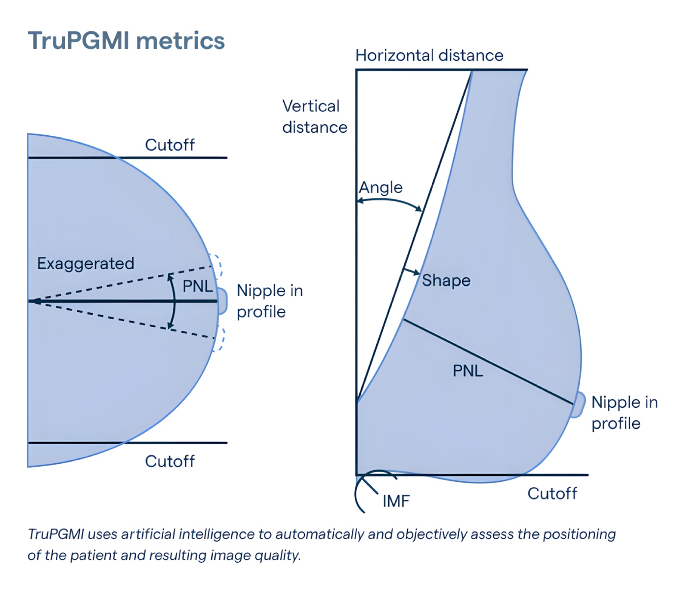 Diagram showing TruPGMI metrics used by mammography quality assurance software to assess breast positioning, compression, and nipple profile accuracy during image acquisition.