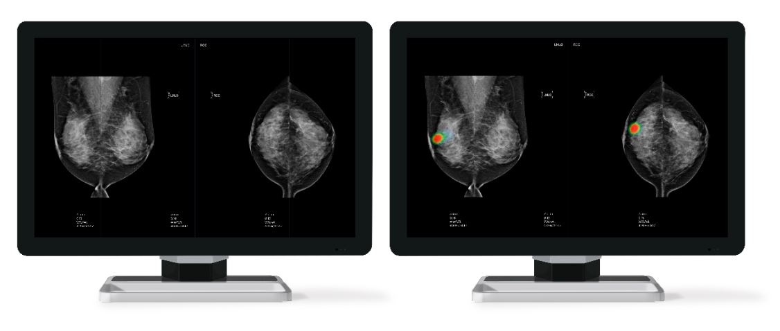 Will AI Identify Breast Cancer Better Than Radiologists in Actual ...