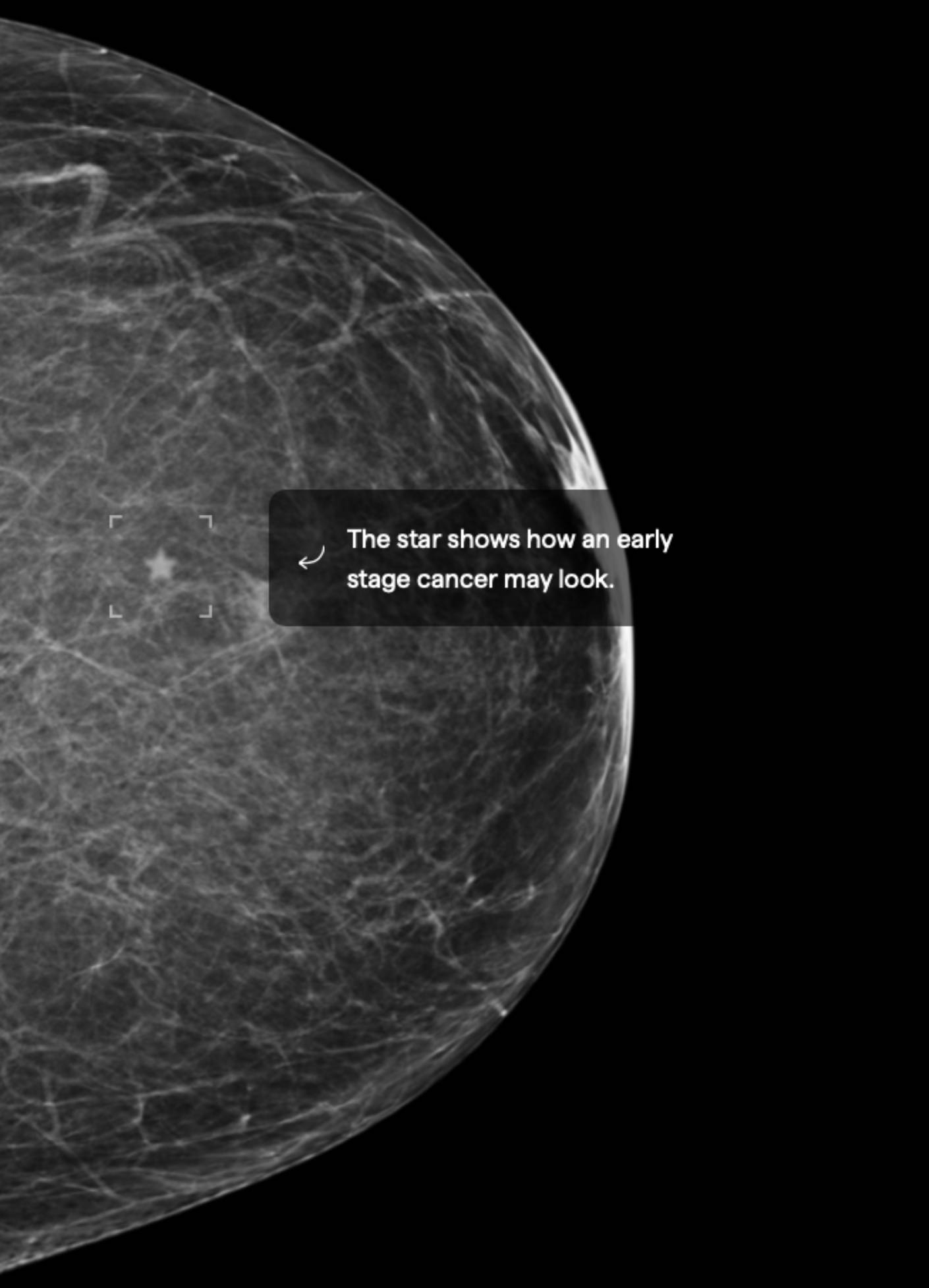 A Low tissue density ALMOST ENTIRELY FATTY
