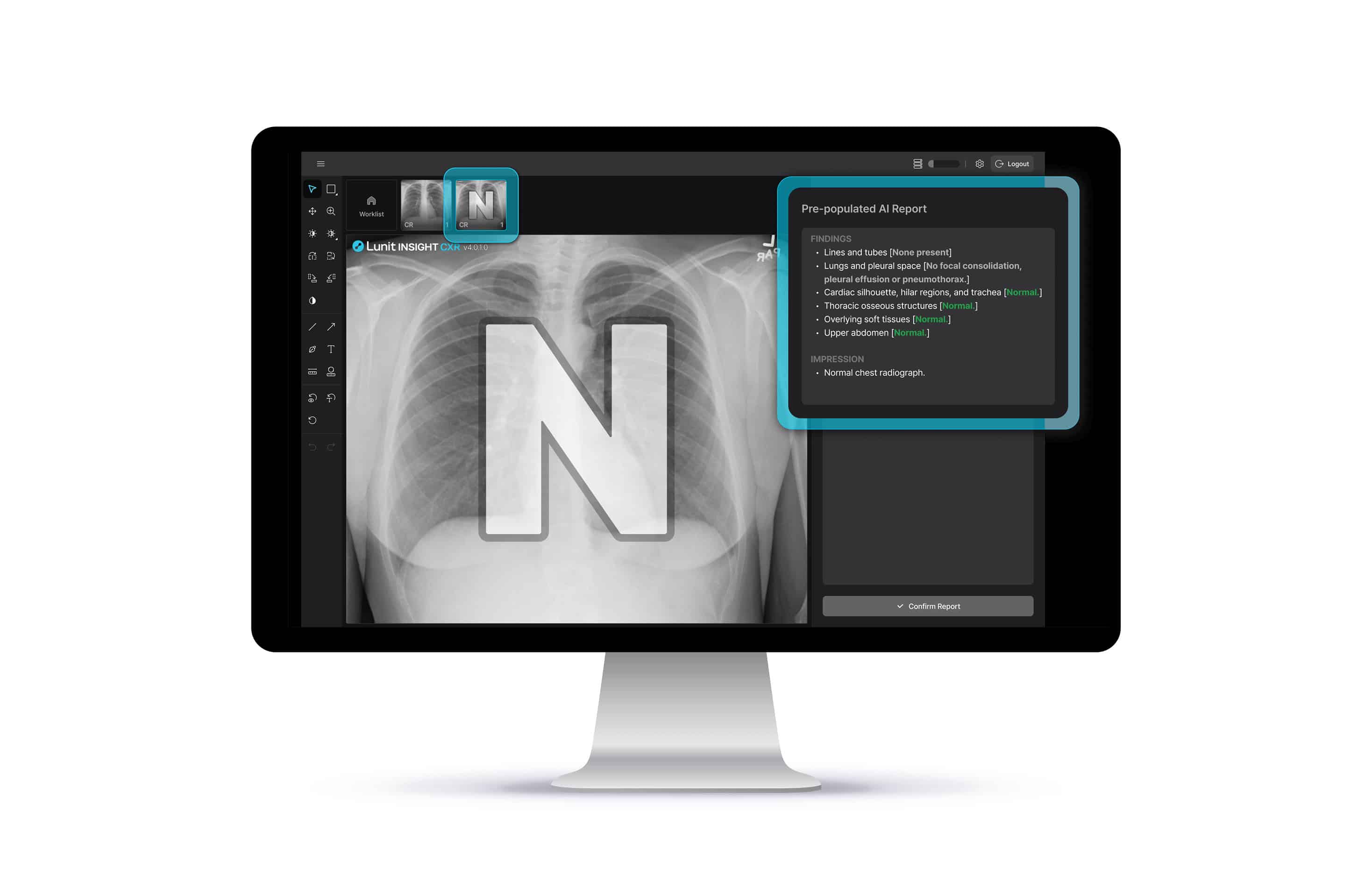 Focus on what matters–normal CXRs are streamlined