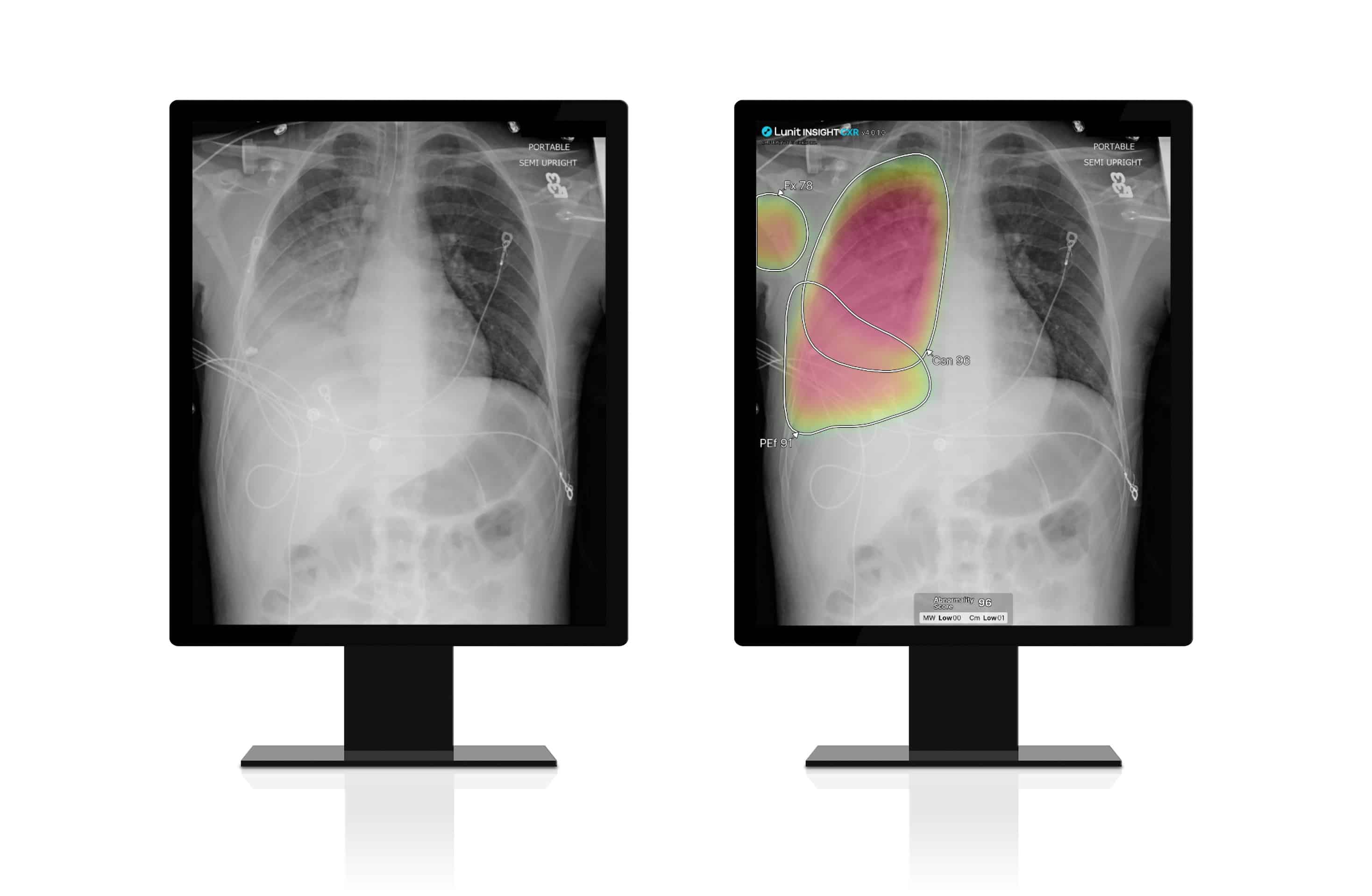 Improved detection of subtle fractures